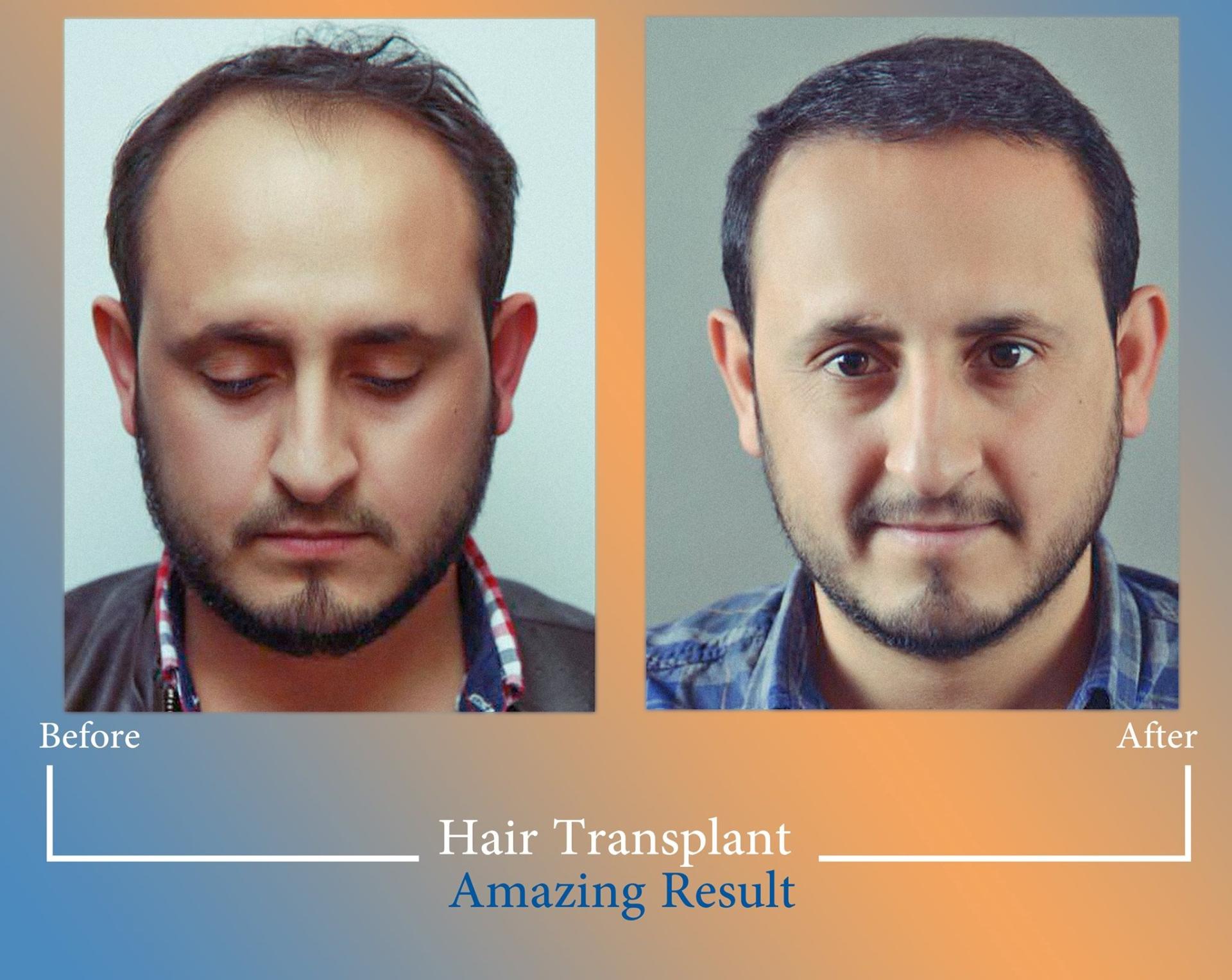 Hair Trans Turkey
